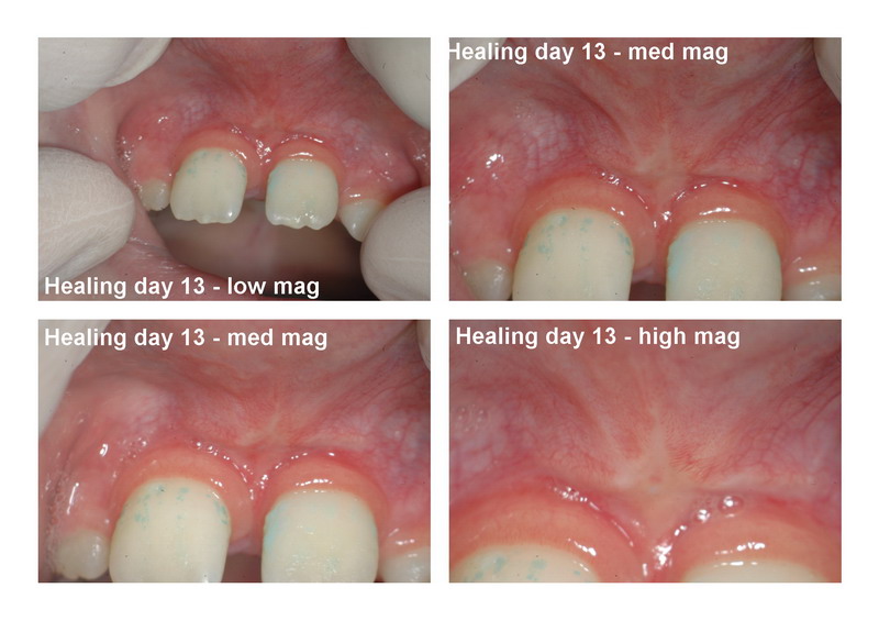 Frenectomy day 13 healing_resize.jpg